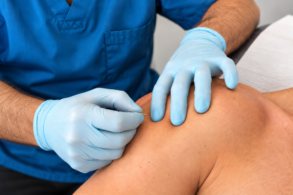 Dry needling treatment of the anterior deltoid at JK Therapy Dublin